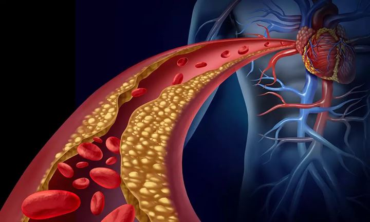 Aterosklerosis yang menunjukkan perbandingan antara arteri sehat dan arteri dengan aterosklerosis, memperlihatkan perbedaan dalam aliran darah dan ketebalan dinding arteri